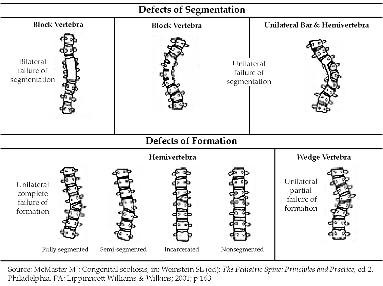 Scoliosis In Adults | BMUS: The Burden Of Musculoskeletal Diseases In ...